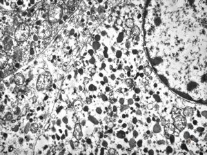 M, 62y. | pheochromocytoma